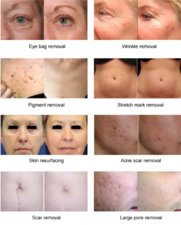 Fractional CO2 laser